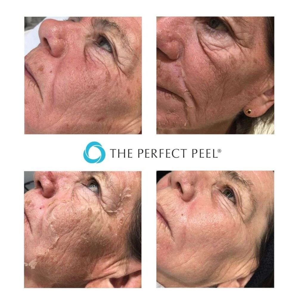 Copy-of-the-perfect-peel-before-after