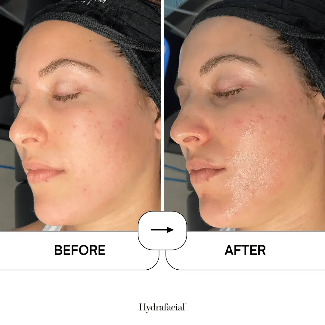 Hydrafacial before and after