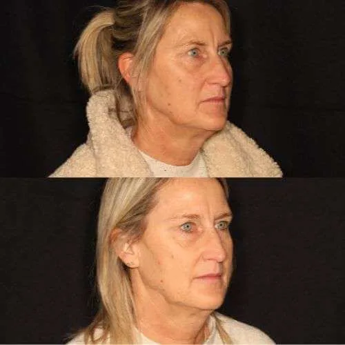 Skin-Boosters (1)