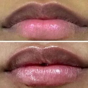 Lip Filler Before & After