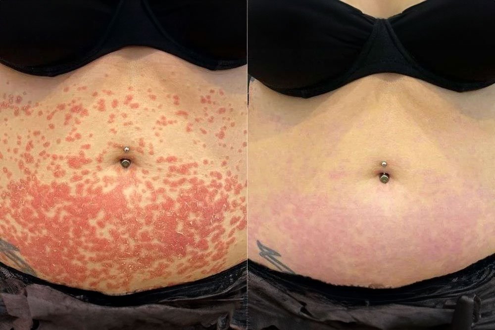 Dermalux-gallery-2