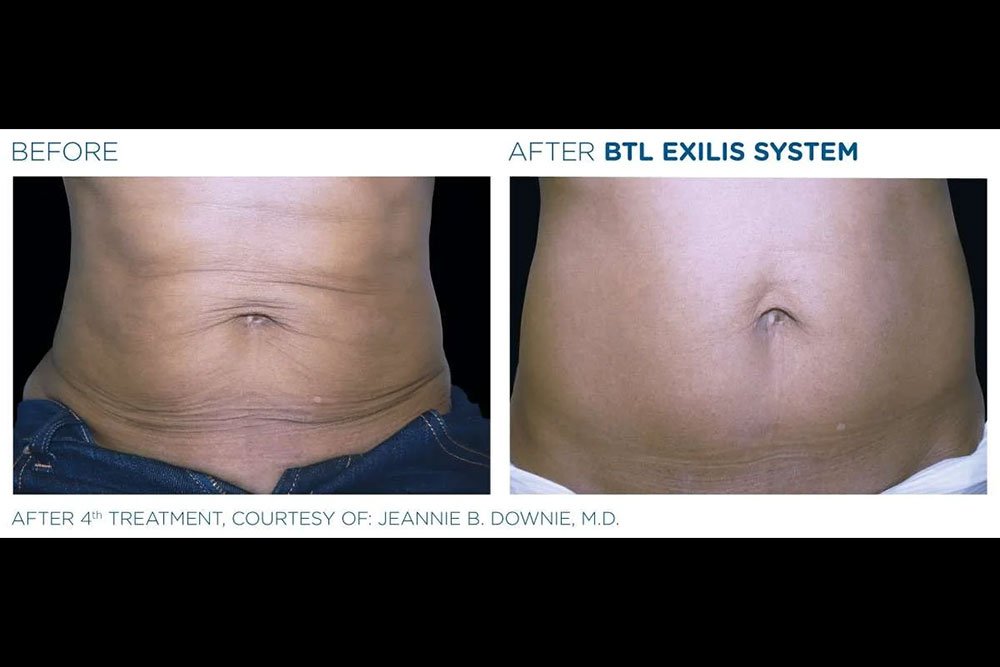 Exilis_gallery-1