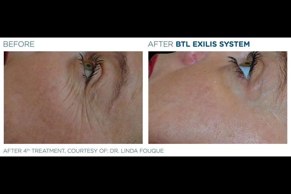 Exilis_gallery-12