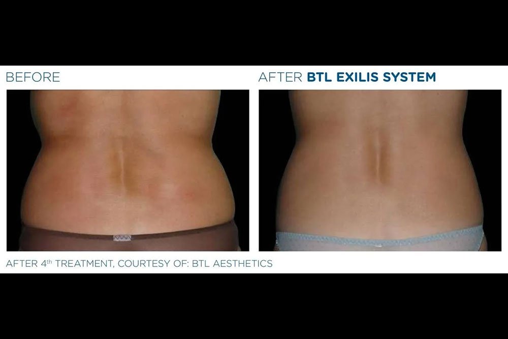 Exilis_gallery-2
