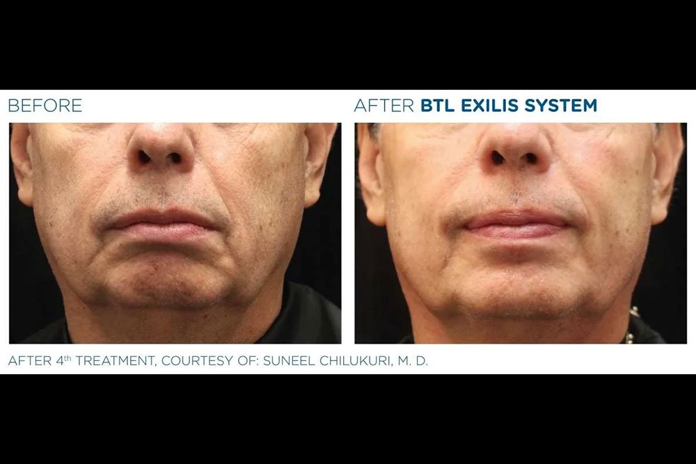 Exilis_gallery-3