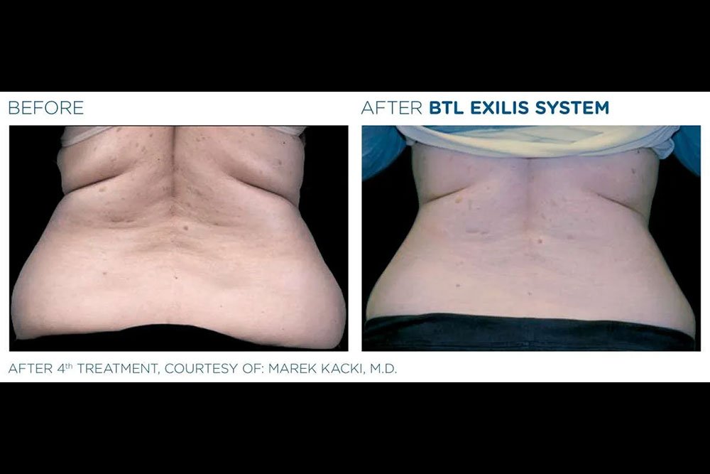 Exilis_gallery-4