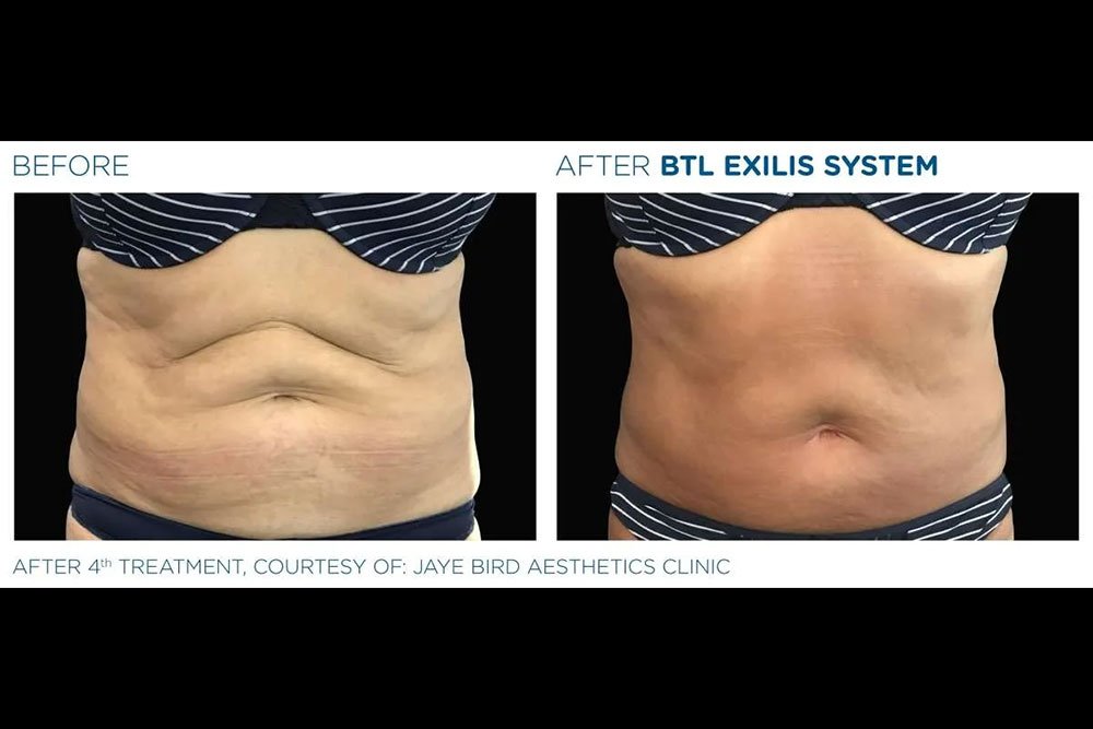 Exilis_gallery-5