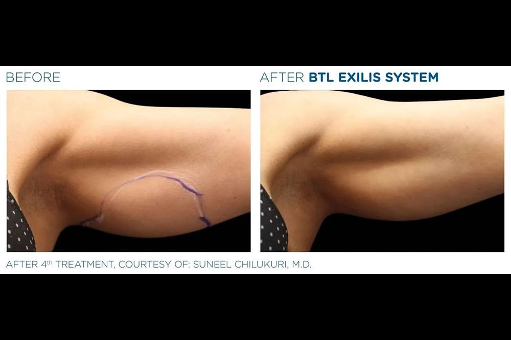 Exilis_gallery-6