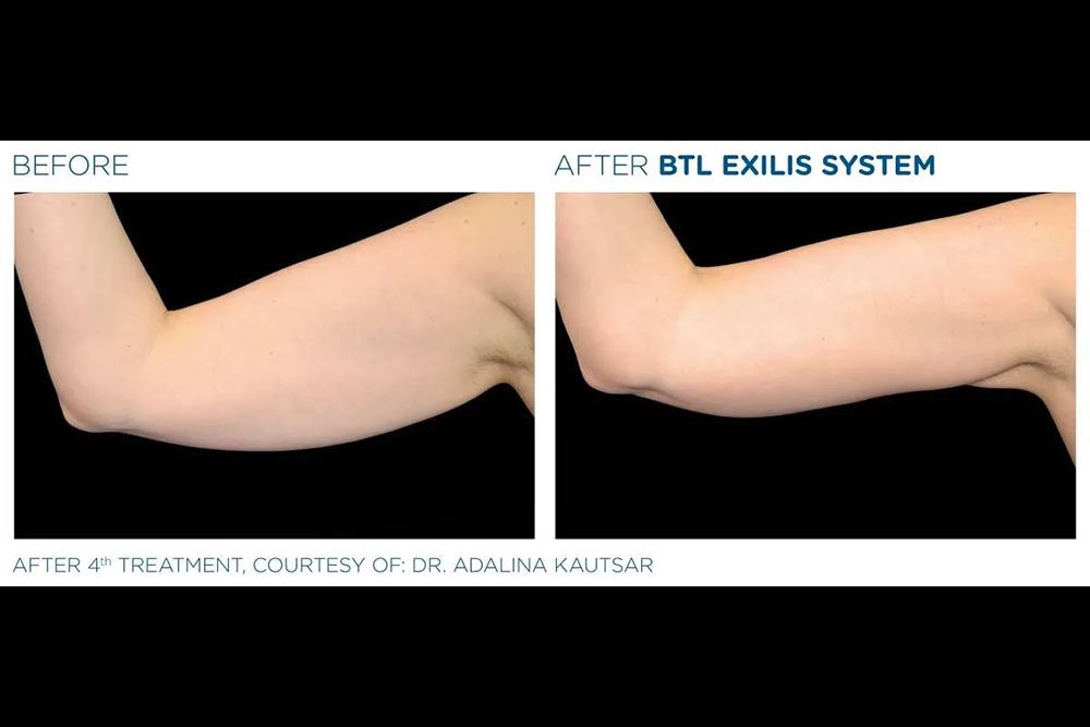Exilis_gallery-7