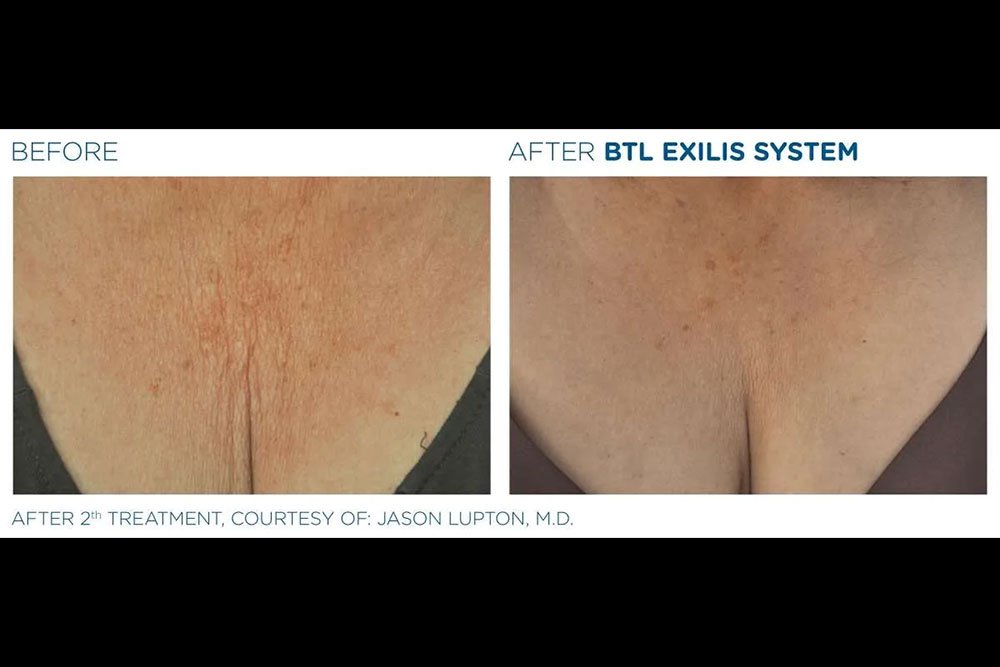 Exilis_gallery-8