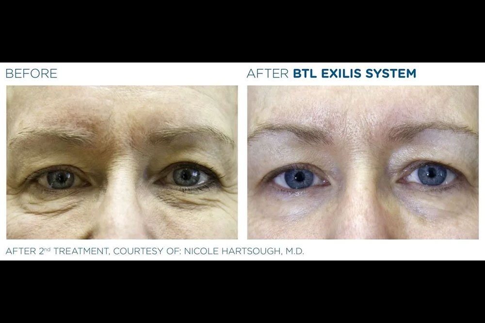 Exilis_gallery-9