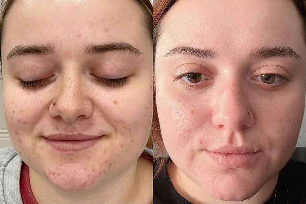 Skin-results-10
