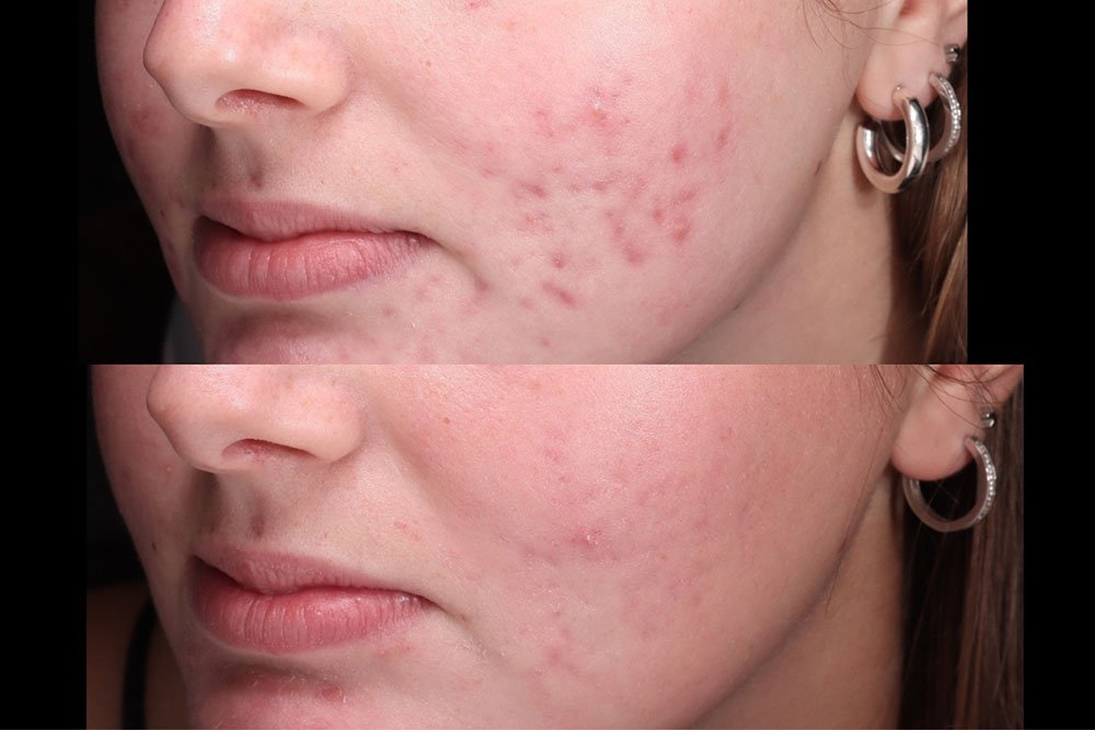 Skin-results-5