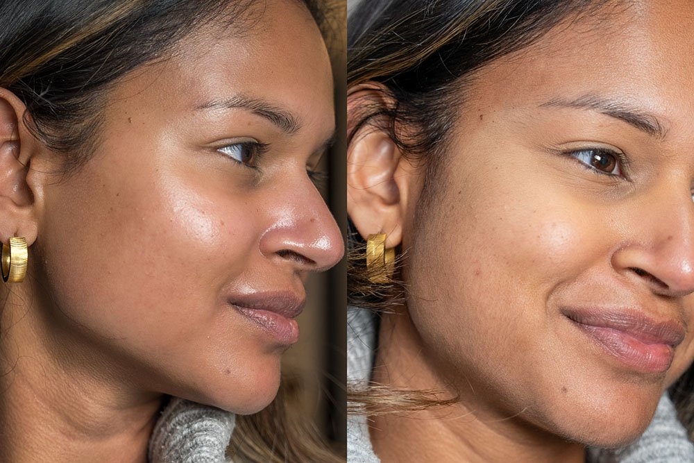 Skin-results-6