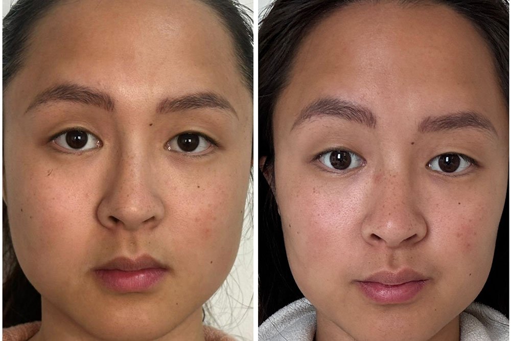 Skin-results