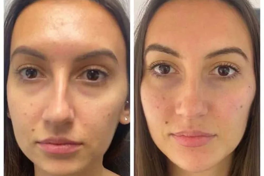 anti-wrinkle-gallery-1
