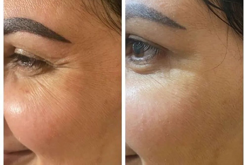 anti-wrinkle-gallery-2