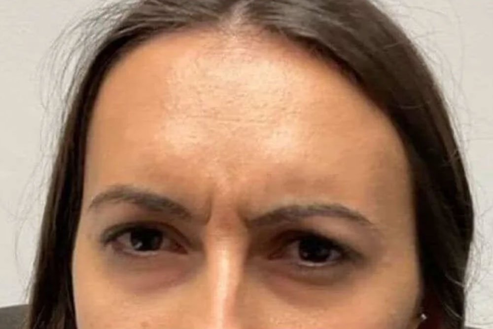 anti-wrinkle-gallery-3