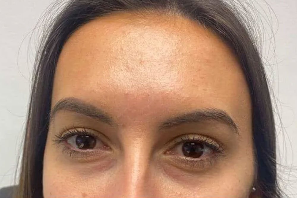 anti-wrinkle-gallery-4