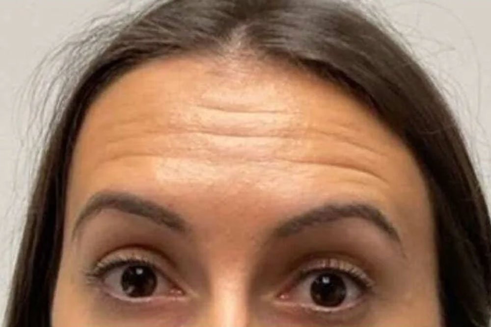 anti-wrinkle-gallery-5