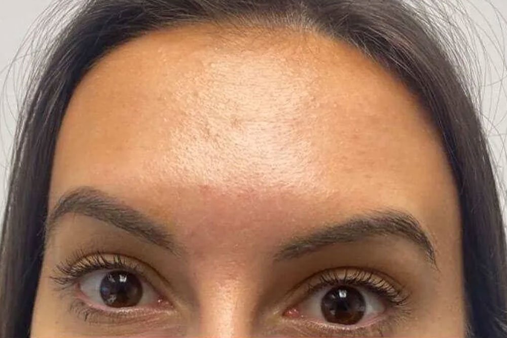 anti-wrinkle-gallery-6