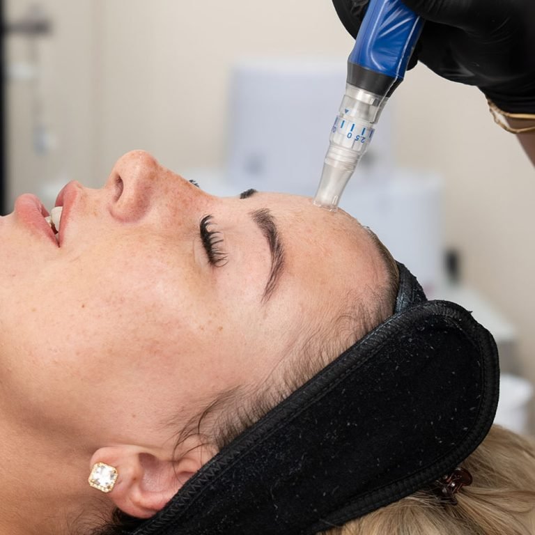 New-Microneedling-1