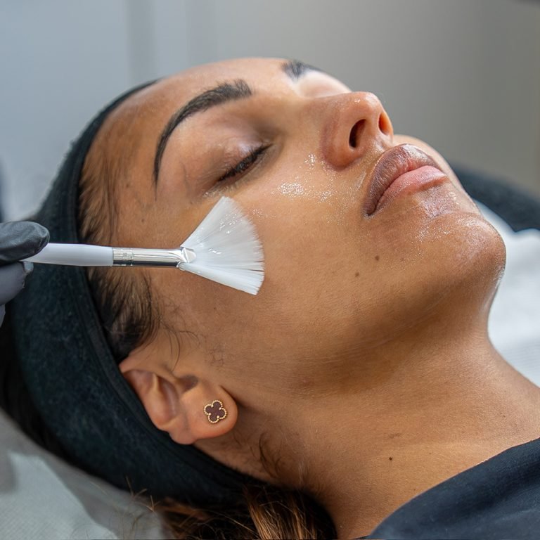 chemical_peel